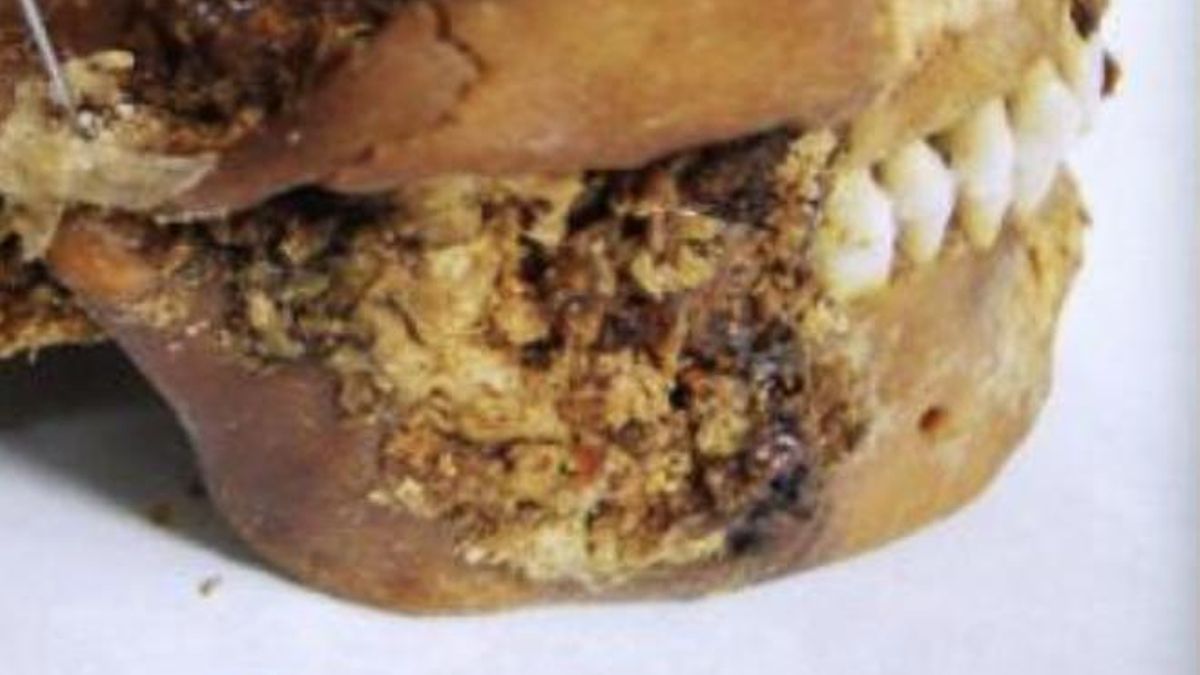 Los restos de una momia siberiana de 2500 años muestran una cirugía de mandíbula completamente desconcertante