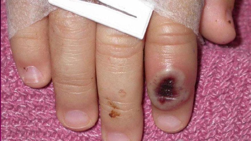 Virus del mono: los positivos deberán aislarse y sus contactos usar mascarilla