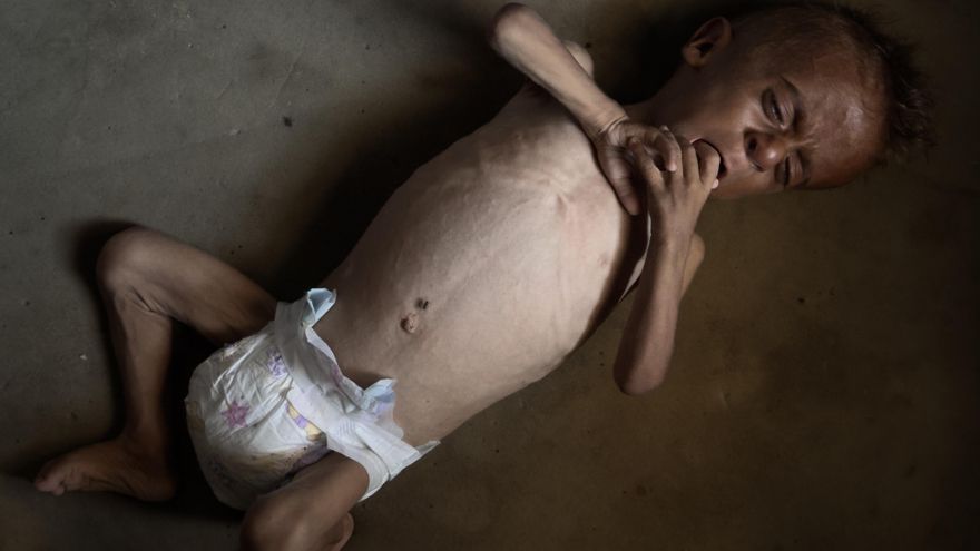 La desnutrición mata a cinco personas, incluido un bebe, en las últimas 24 horas en Gaza