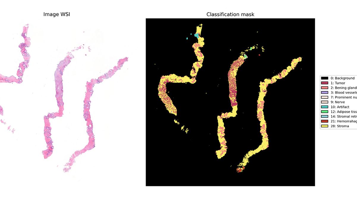 Valdecilla diseña algoritmo de inteligencia artificial para cribado de cáncer de próstata