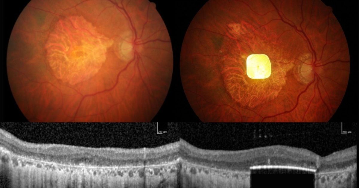 Una prótesis ocular permite leer a personas con ceguera irreversible
