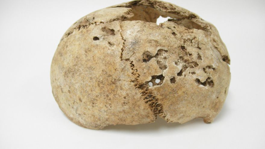 La sífilis no llegó de Europa: detectada la infección en América mil años antes de la llegada de Colón