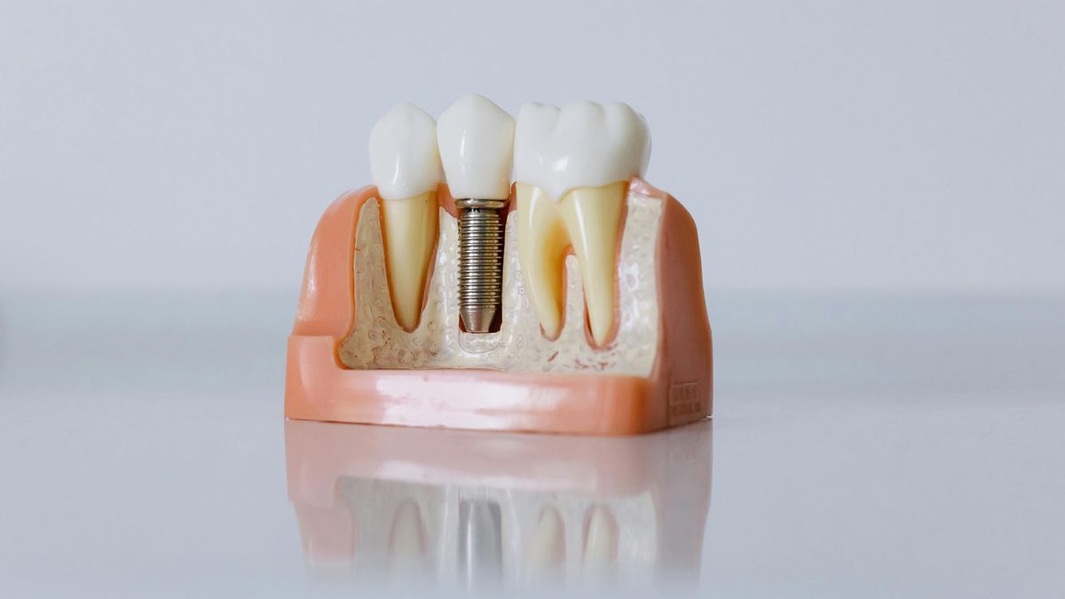 La odontología se acerca al diente perfecto con un implante que crece, se adapta y transmite señales al cerebro
