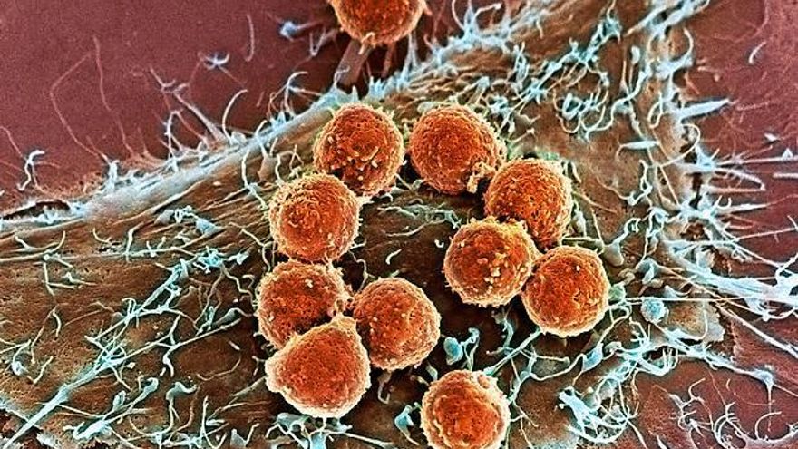 ¿Por qué las terapias más avanzadas contra el cáncer solo funcionan en algunos pacientes?