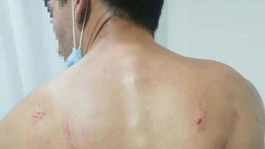 Heridas de uno de los participantes tras la pela