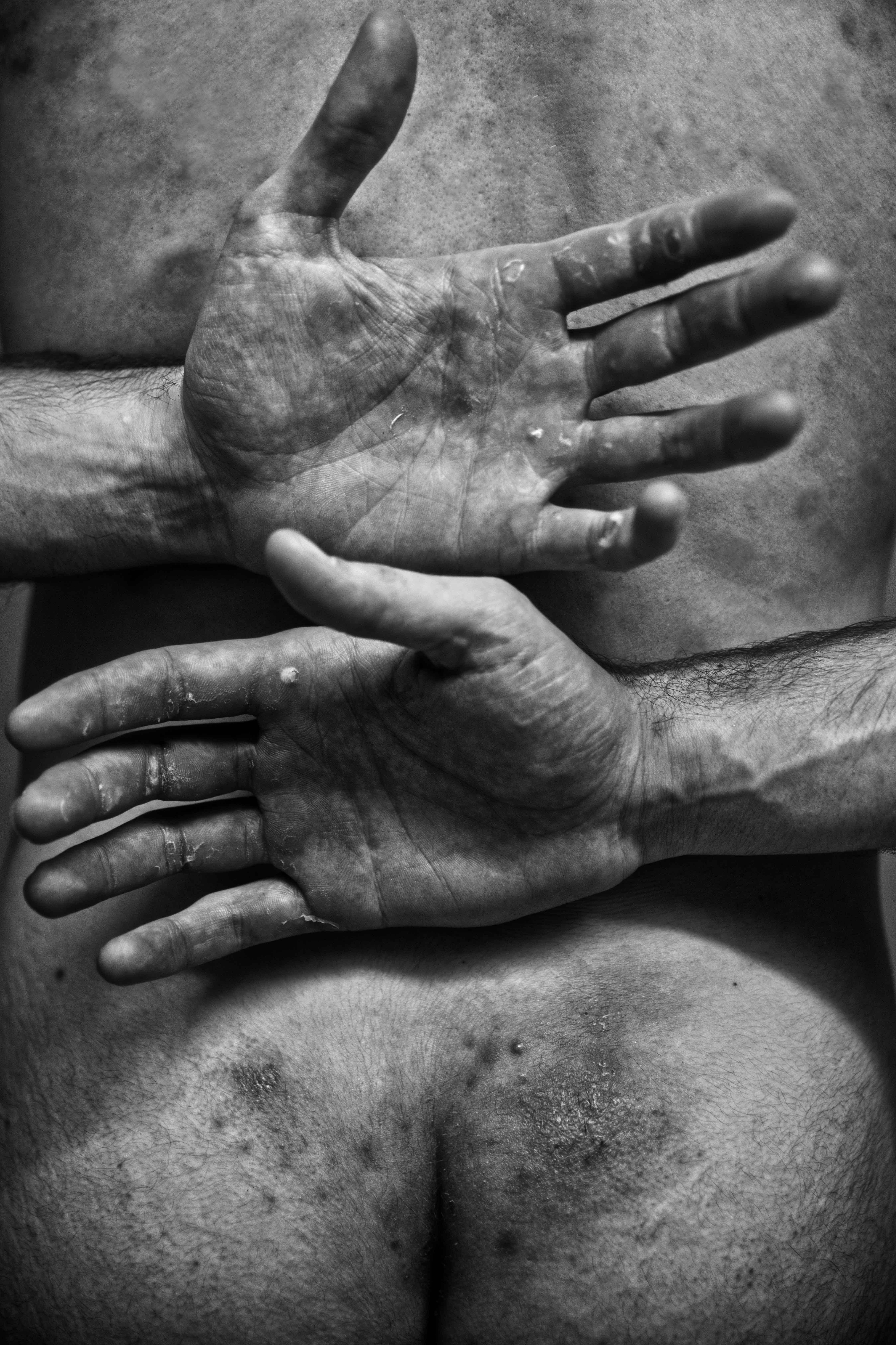 Las secuelas de una vida dedicada al remo. | HUMBERTO BILBAO ®