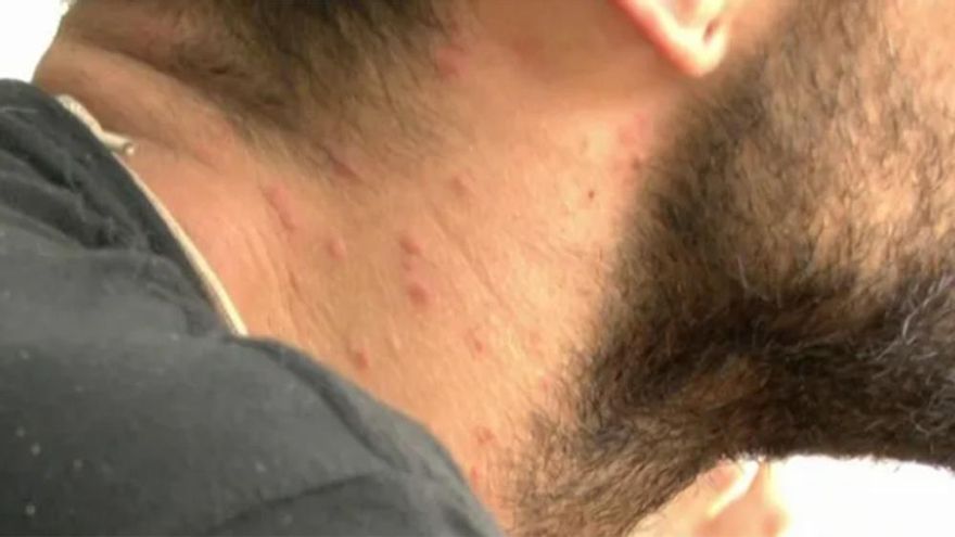 El cuello de Barranco por culpa de los mosquitos