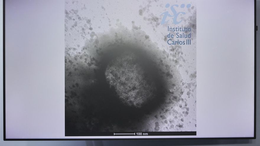 Negativo el último caso pendiente de confirmarse como viruela del mono en Castilla-La Mancha