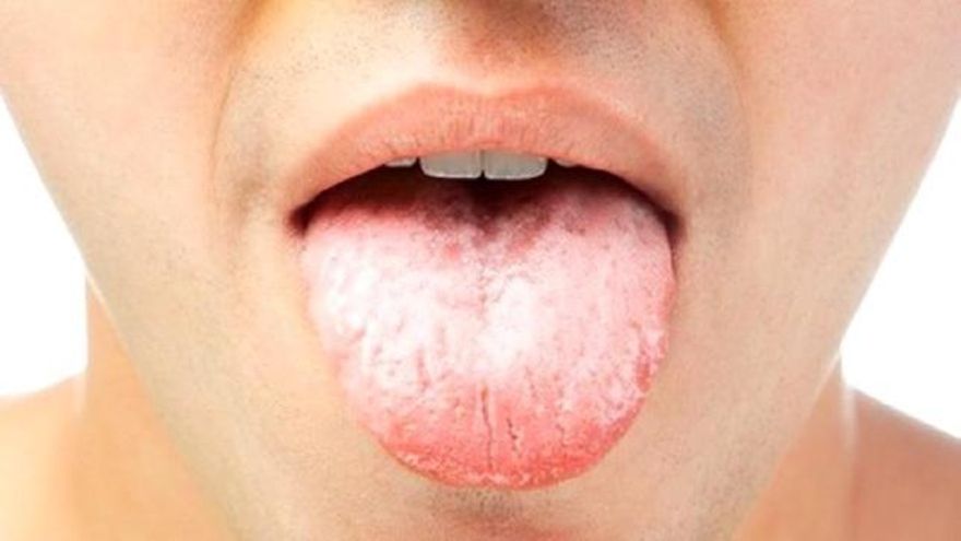 Úlceras recurrentes en la lengua: ¿cuándo esconden una enfermedad grave?