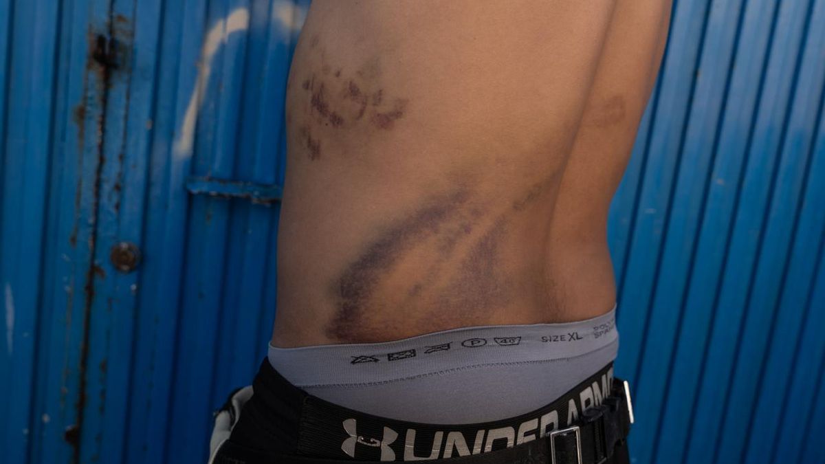 Ahmed (nombre ficticio) muestra las contusiones de su espalda que, según denuncia, fueron provocadas por una paliza de varios militares en la playa de la Almadraba (Ceuta)