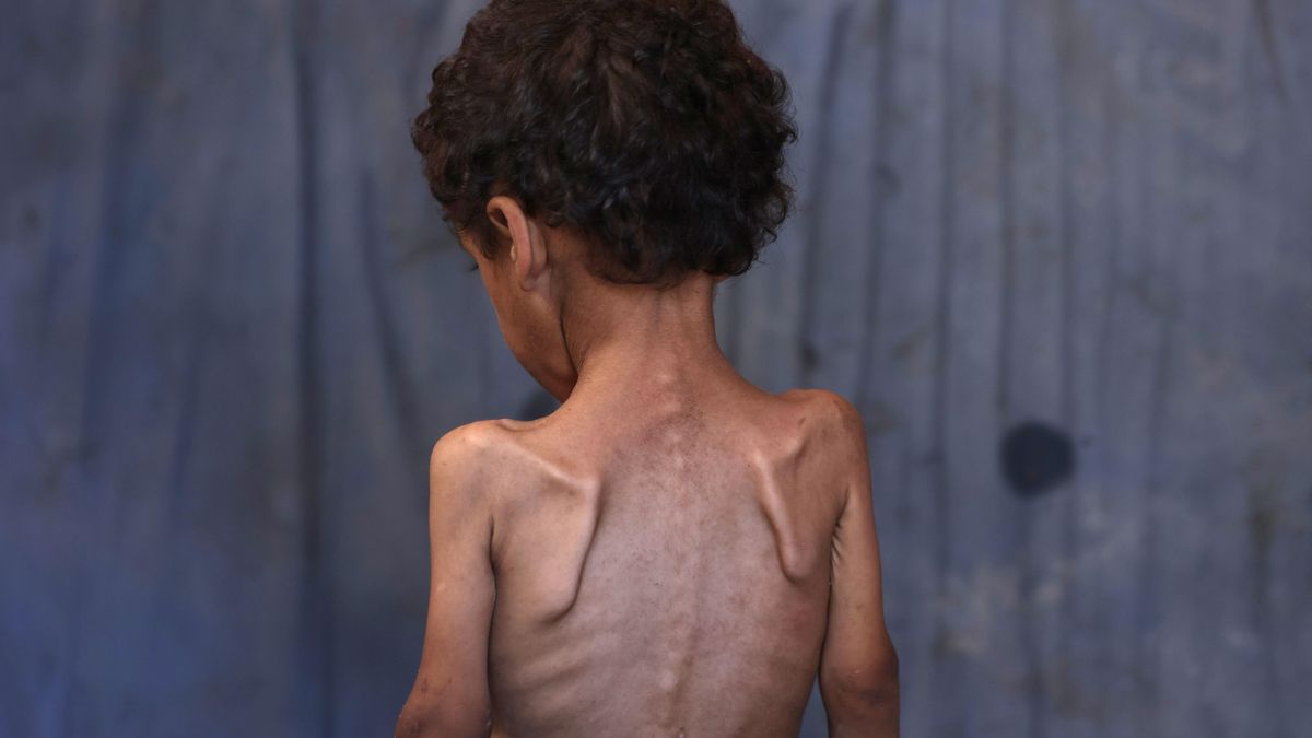 Un niño palestino desnutrido de dos años, identificado como Yazan.