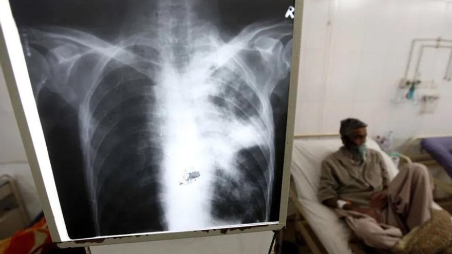 El frágil control de la tuberculosis se resquebraja en el mundo: España revisa su plan para revertir el ascenso de casos
