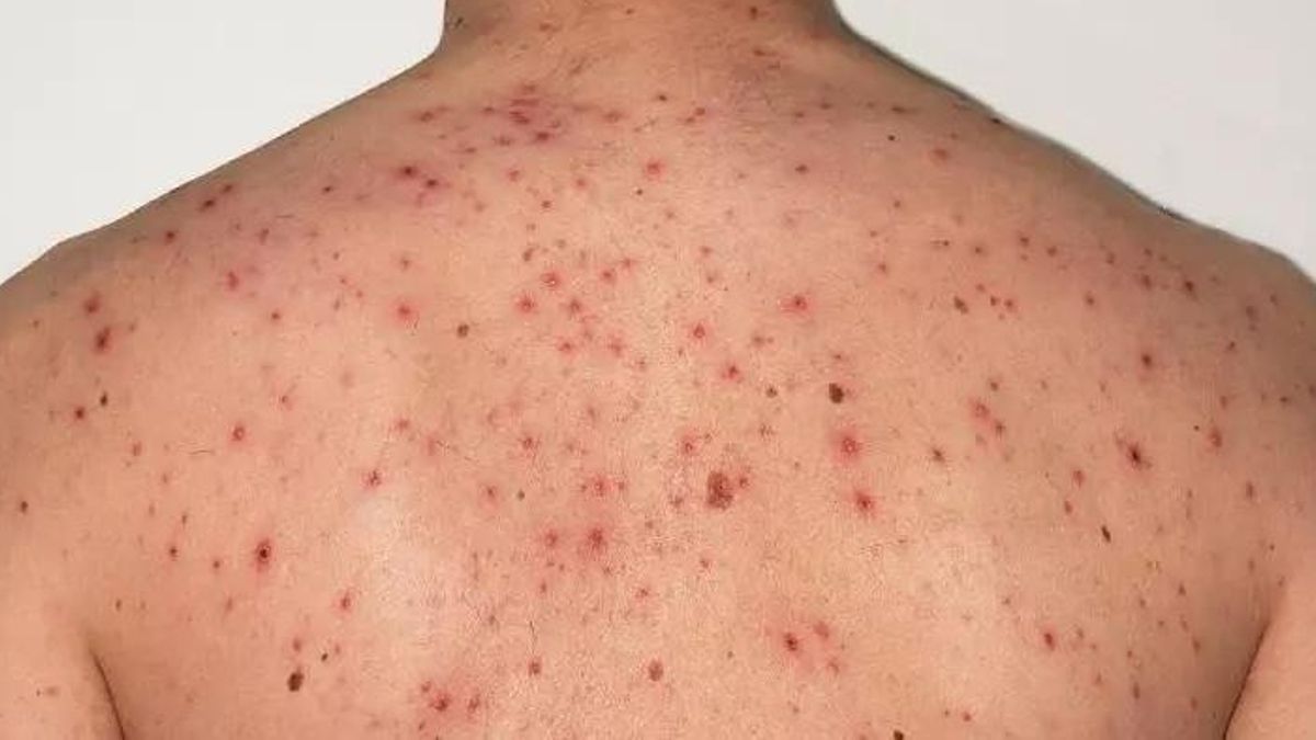 Imagen de archivo de un afectado por sarampión.