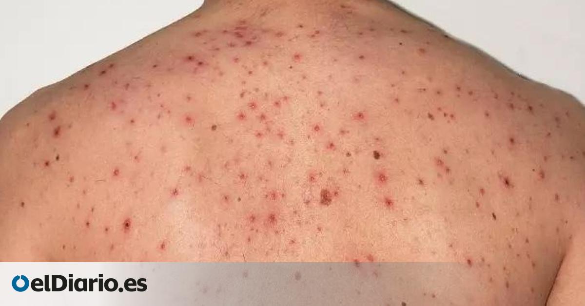Salud Pública eleva a 14 los casos confirmados en el brote de sarampión en La Palma