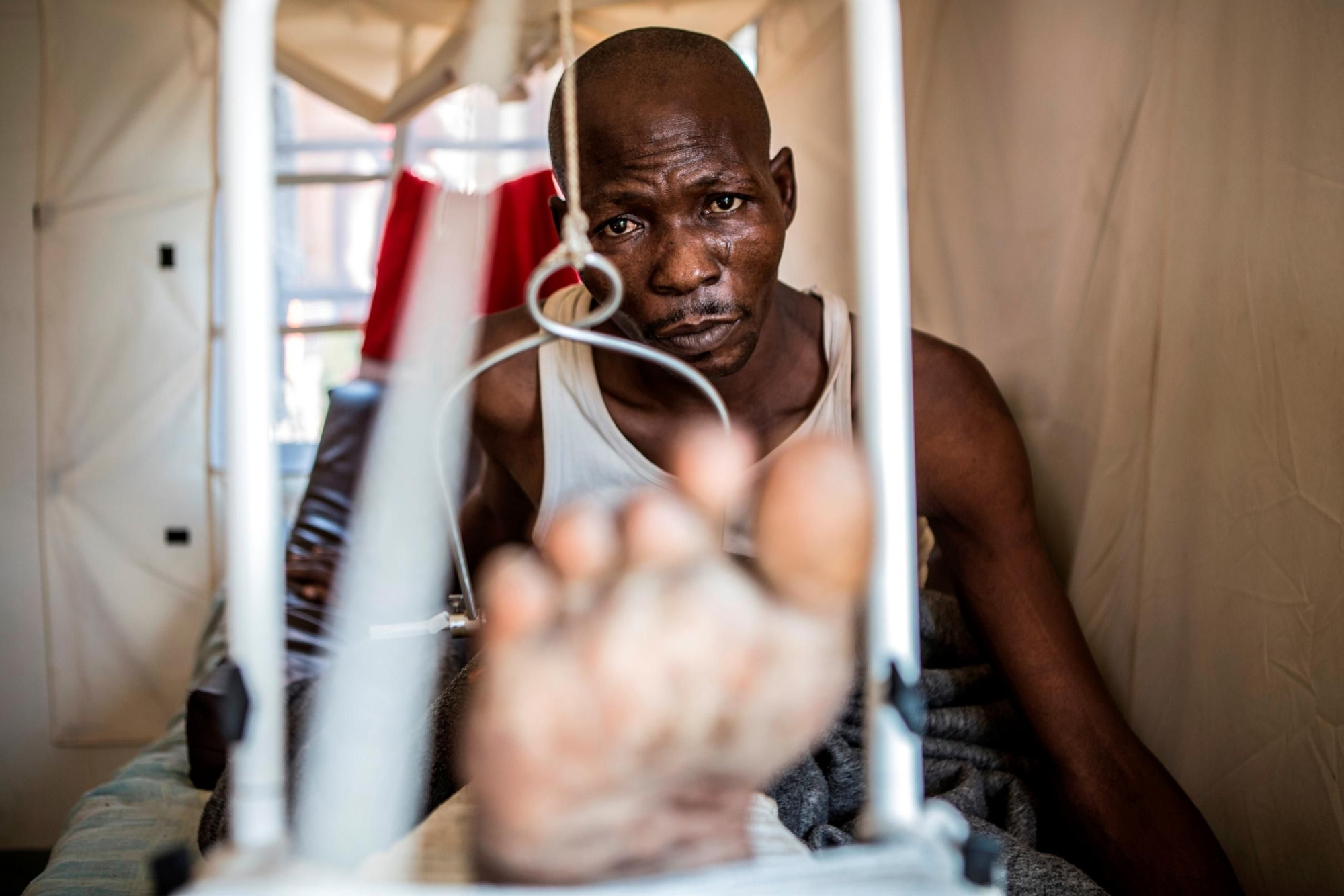 Un paciente herido en el Hospital Comunitario de Bangui. Un gran número de pacientes resultaron heridos en los combates entre los grupos anti-Balaka y las fuerzas ex-Séléka y presentan lesiones provocadas por armas caseras como palos con clavos, hachas y machetes. Fotografía: Juan Carlos Tomasi/MSF