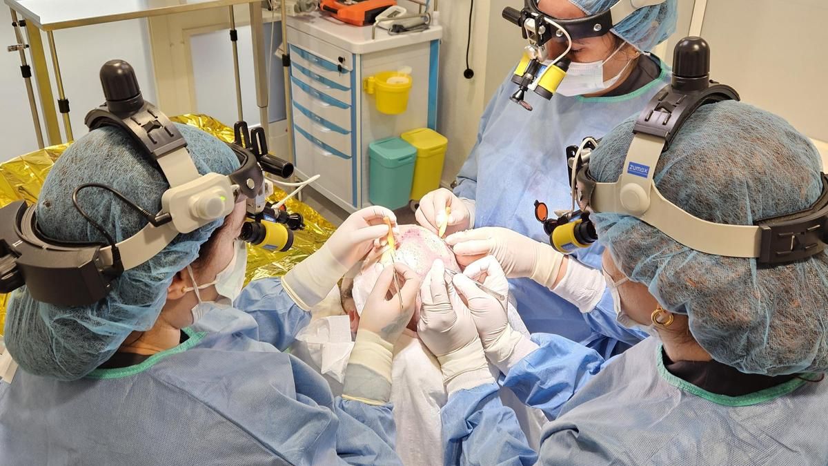 Cinco ideas erróneas sobre trasplante capilar que pueden costar caras