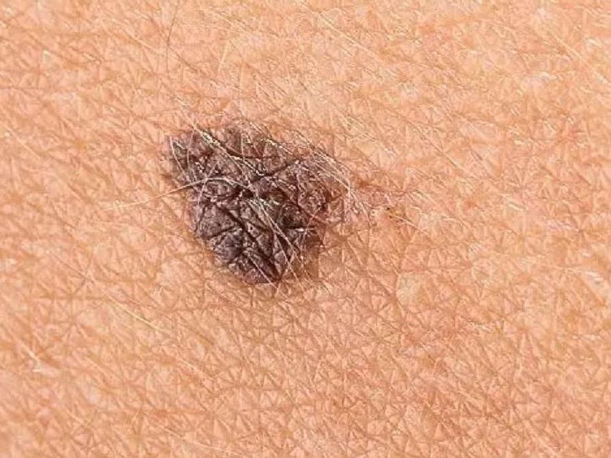 Un melanoma en la piel humana.