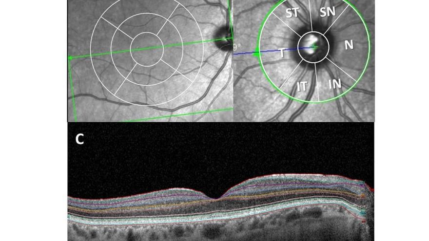 Examen de la retina con la Tomografía de Coherencia Óptica (OCT).