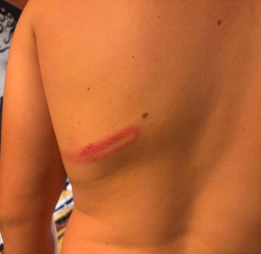 Magulladuras en la espalda de una de las personas golpeadas por la policía durante la protesta de profesores