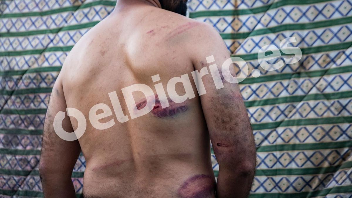 La espalda de Bilal cubierta de marcas alargadas en su espalda.