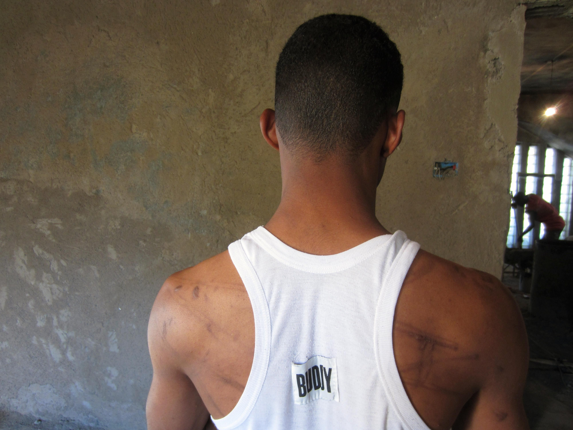 MAYO. La tortura sigue siendo una de las violaciones de derechos humanos que se comete con más impunidad. Este prisionero de Libia, que muestra las cicatrices que le han dejado los golpes recibidos, fue liberado sin cargos tres días después de estar bajo la custodia de las milicias armadas. Miles de personas se embarcan en viajes peligrosos tratando de alcanzar Europa para huir de violaciones de derechos humanos que se cometen en sus países. Sin embargo, no son bien recibidos. En 2012 Italia firmó un acuerdo con Libia sobre el control de la migración, sin garantías efectivas para los derechos humanos #ddhhSinFronteras // © Amnesty International