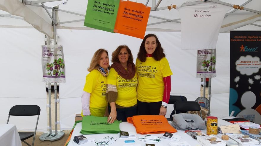 Vivir con acromegalia, la enfermedad rara que hace que crezcan las extremidades: "La sufren muchos más, pero no lo saben"