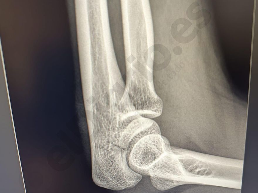 Radiografía de Ainhoa, donde se muestra la fractura del olécranon (cúbito).
