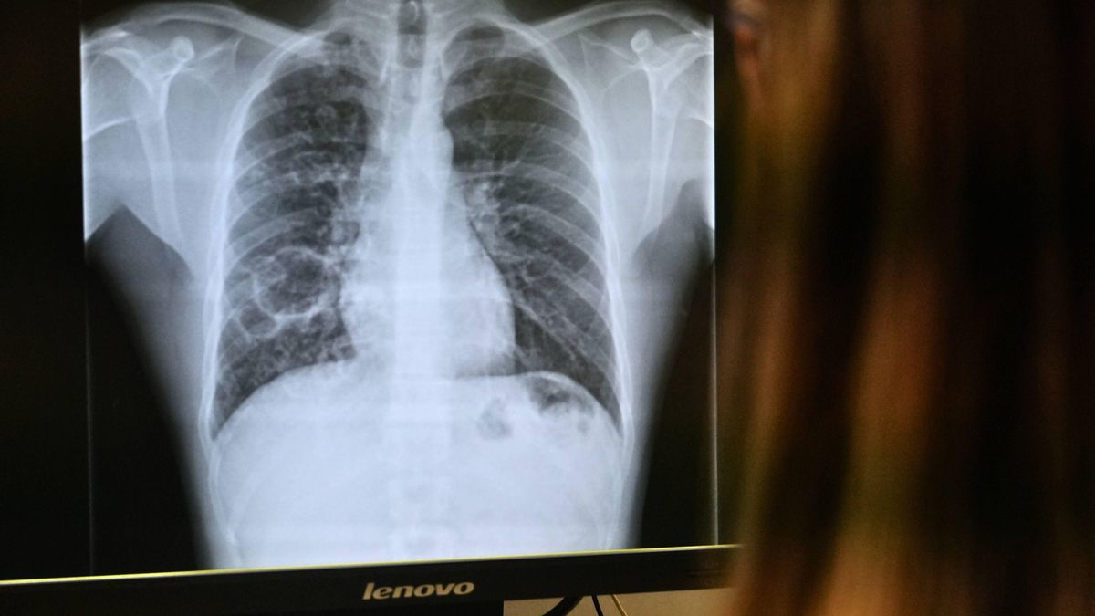 Detectado un caso de tuberculosis en un niño escolarizado en Bilbao