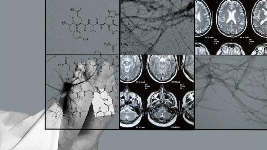Nuevas pruebas de que el alzhéimer se podría transmitir a partir de la inyección de tejidos de cadáveres