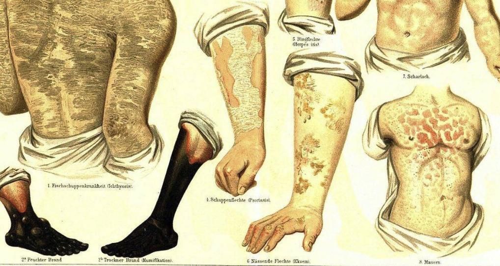 Un hongo del cereal puede causar convulsiones y gangrena