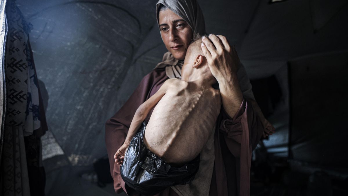 Muhammad Zakariya Ayyoub al-Matouq, un niño de un año y medio de la ciudad de Gaza, se enfrenta a una desnutrición potencialmente mortal.