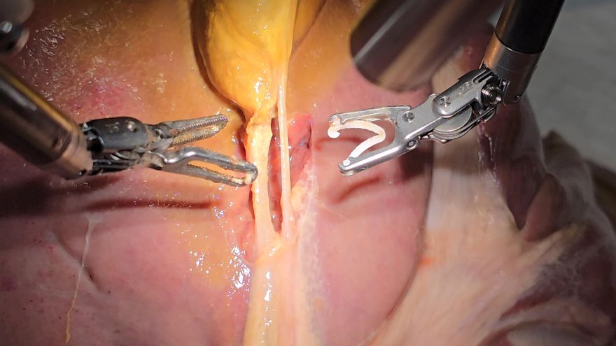 Un robot entrenado con IA y vídeos de cirugías opera una vesícula biliar sin ayuda humana