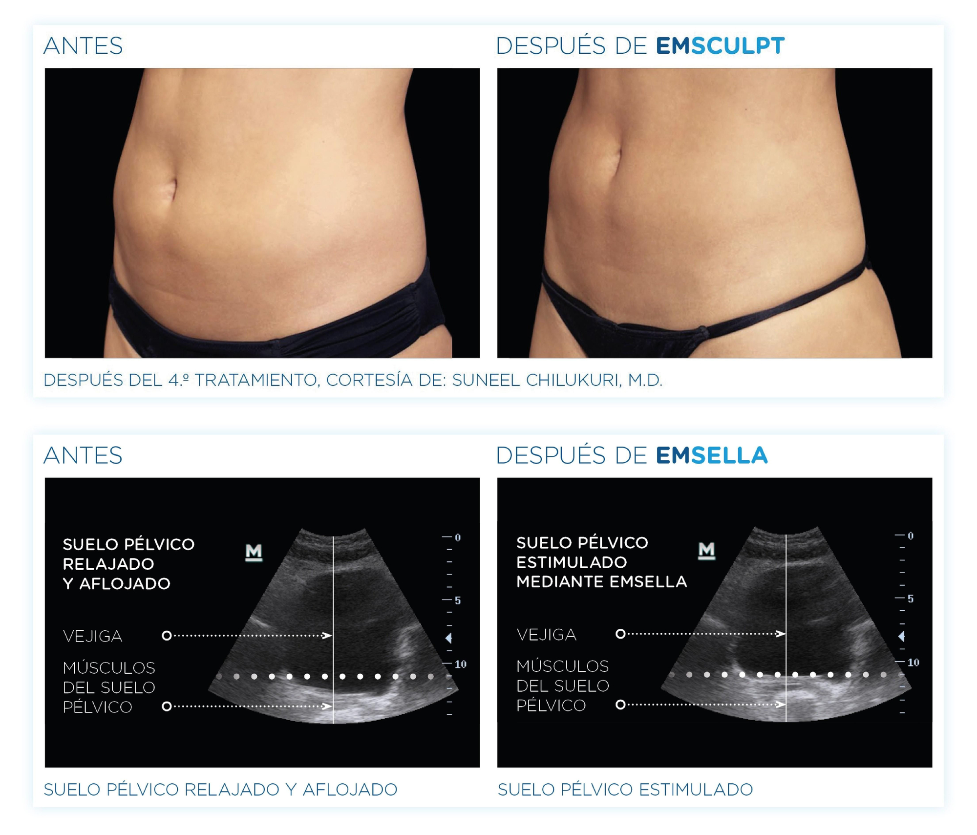 Ecografía del suelo pélvico, antes y después del Emsculpt Neo.