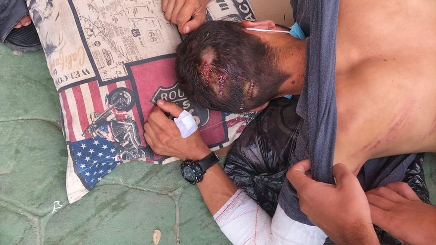 Una de las fotografías tomadas de las lesiones de Mohamed tras ser atendido en el hospital, donde se ven las heridas con grapas de la cabeza, lesiones en los codos y marcas de porras en la espalda.