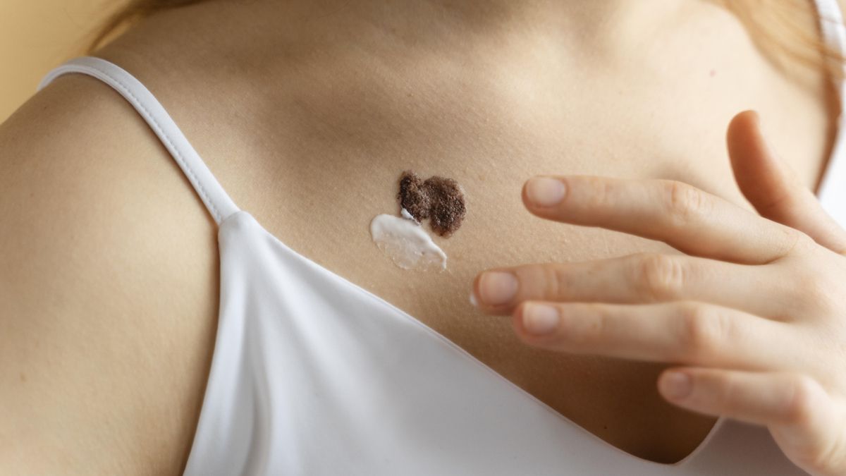 Frente a la presencia de muchos lunares o pecas es importante tener mucho cuidado y evitar las quemaduras solares.