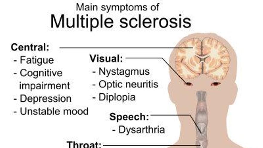 Síntomas de la esclerosis múltiple. Foto DiCyt.