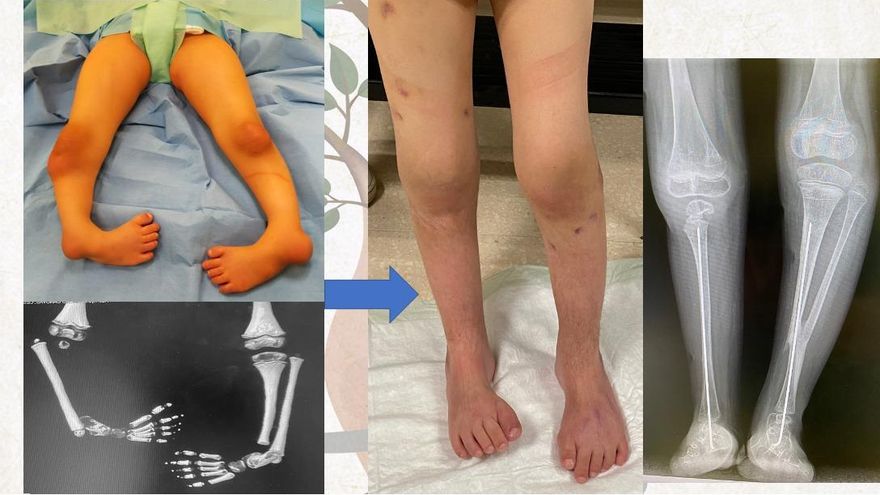Evolución de las piernas de Nour tras las distintas intervenciones