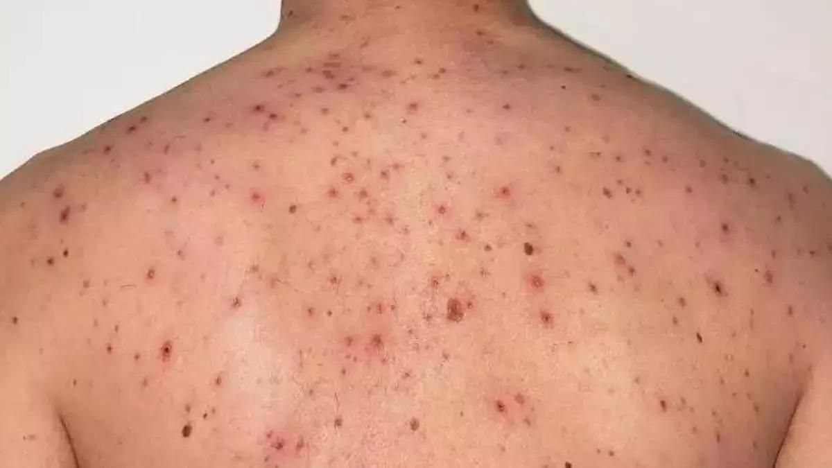 Sanidad cierra el brote de sarampión de La Palma con 56 afectados