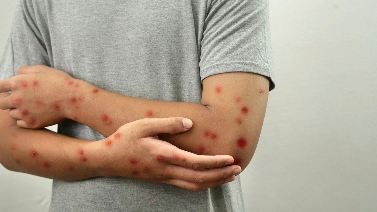 El Servicio Canario de la Salud da por cerrado el brote de sarampión notificado en junio en Tenerife