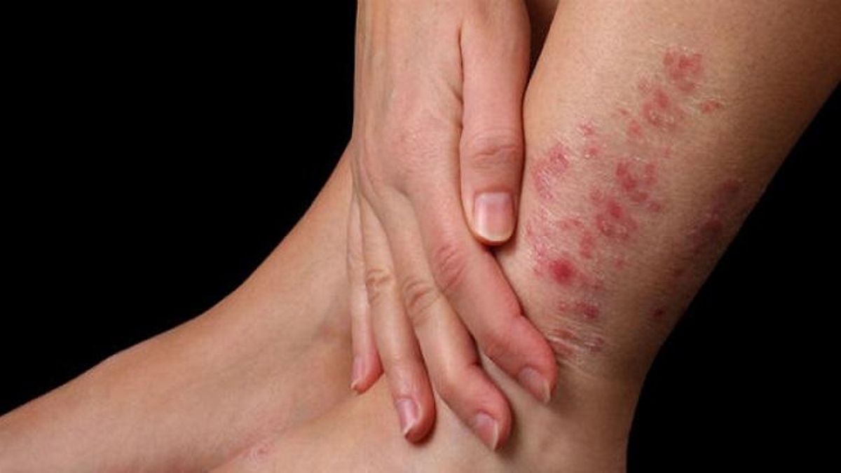 Día Mundial de la Psoriasis: ¿por qué se celebra el 29 de octubre?