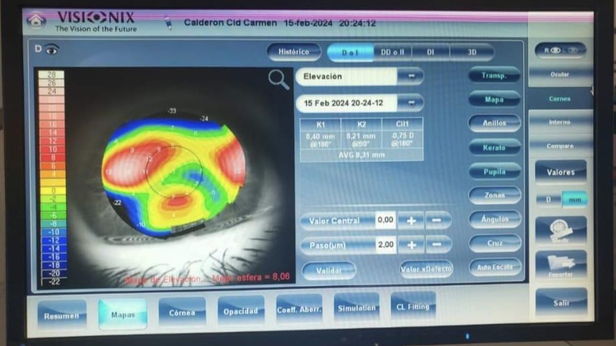 Análisis de una de las córneas de Carmen Calderón, donde se aprecian las zonas dañadas
