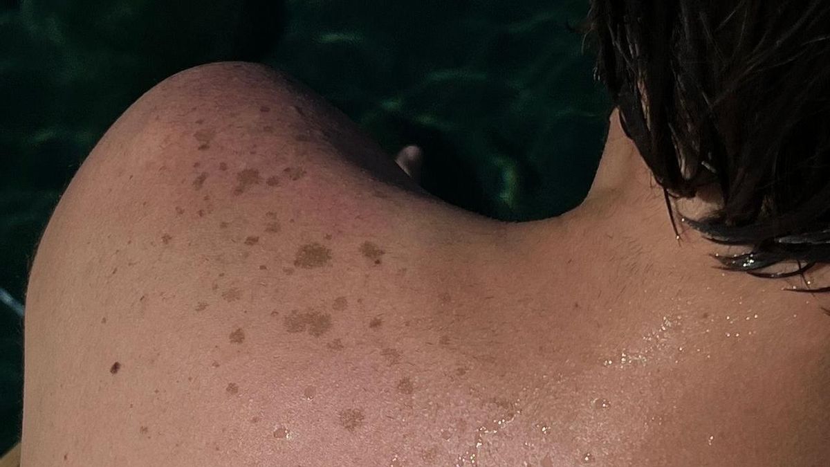 La piel en verano debe protegerse del sol, pero la dieta y las bacterias intestinales influyen en su estado