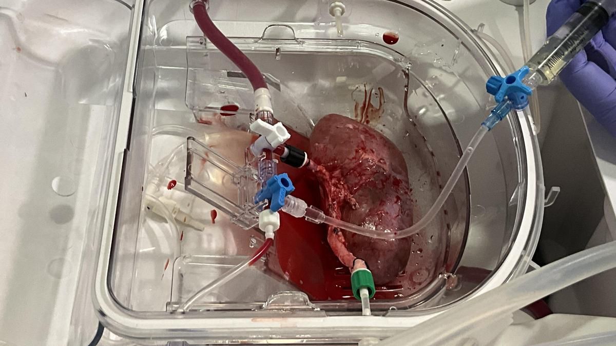 El primer trasplante de organoides renales humanos en cerdos abre una nueva vía para la medicina regenerativa