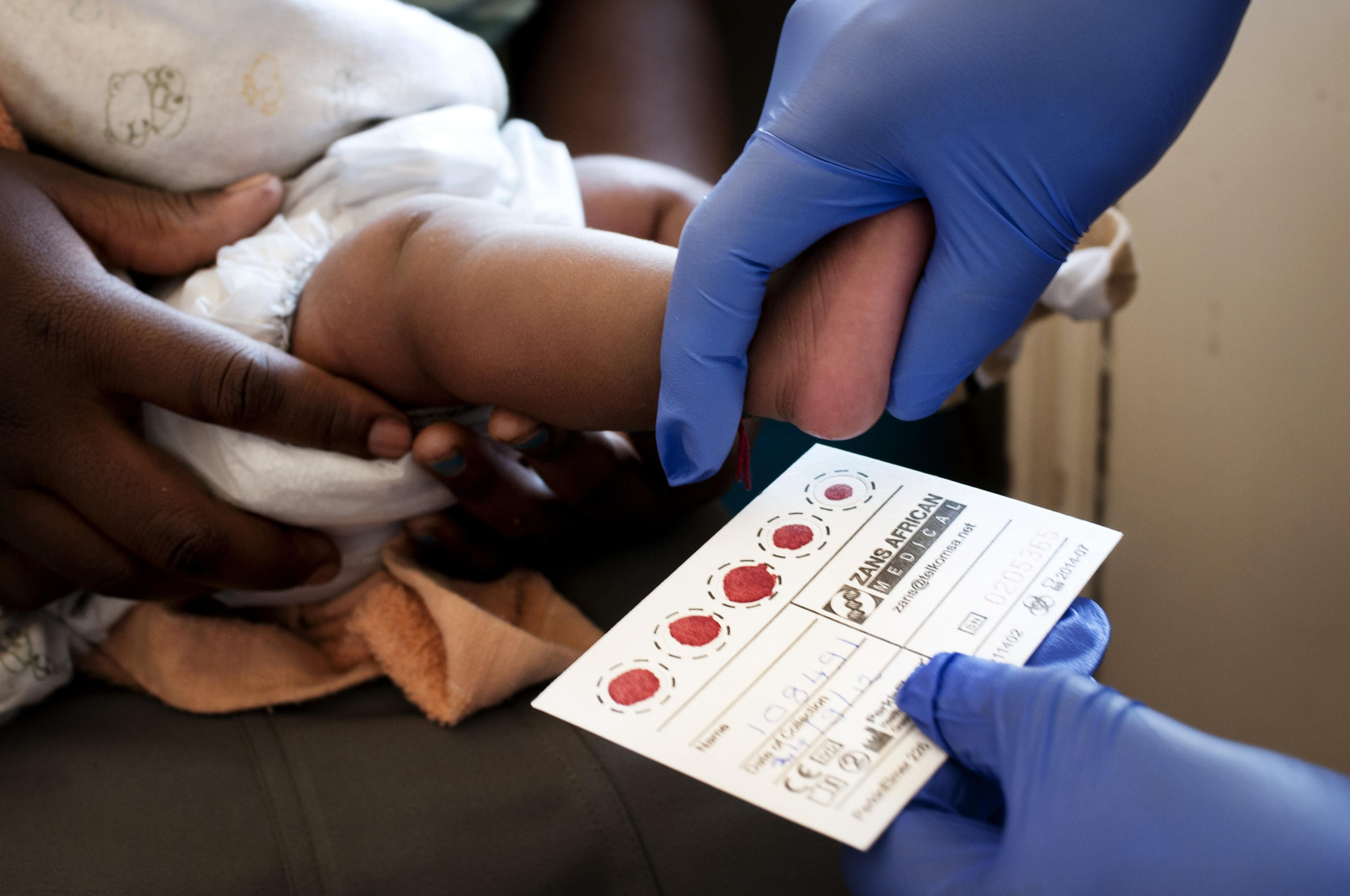 Durante el embarazo, el parto o la lactancia, las madres seropositivas pueden transmitir el virus a sus hijos en entre un 15 y un 45% de los casos. El tratamiento completo de para prevenir la transmisión cuesta aproximadamente 100 dólares. Prueba para comprobar si un recién nacido con seis semanas da positivo o negativo en el test del VIH.