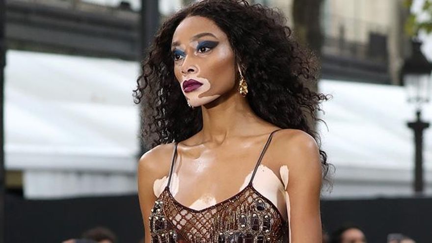 Vitíligo, ¿qué ocurre cuando la piel pierde su color?