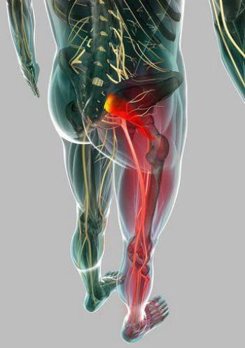 Un dolor ciático puede ser debido a una compresión radicular e inflamación provocada por una hernia de disco lumbar o al Síndrome del Piriforme. El diagnóstico es la clave para la recuperación.
