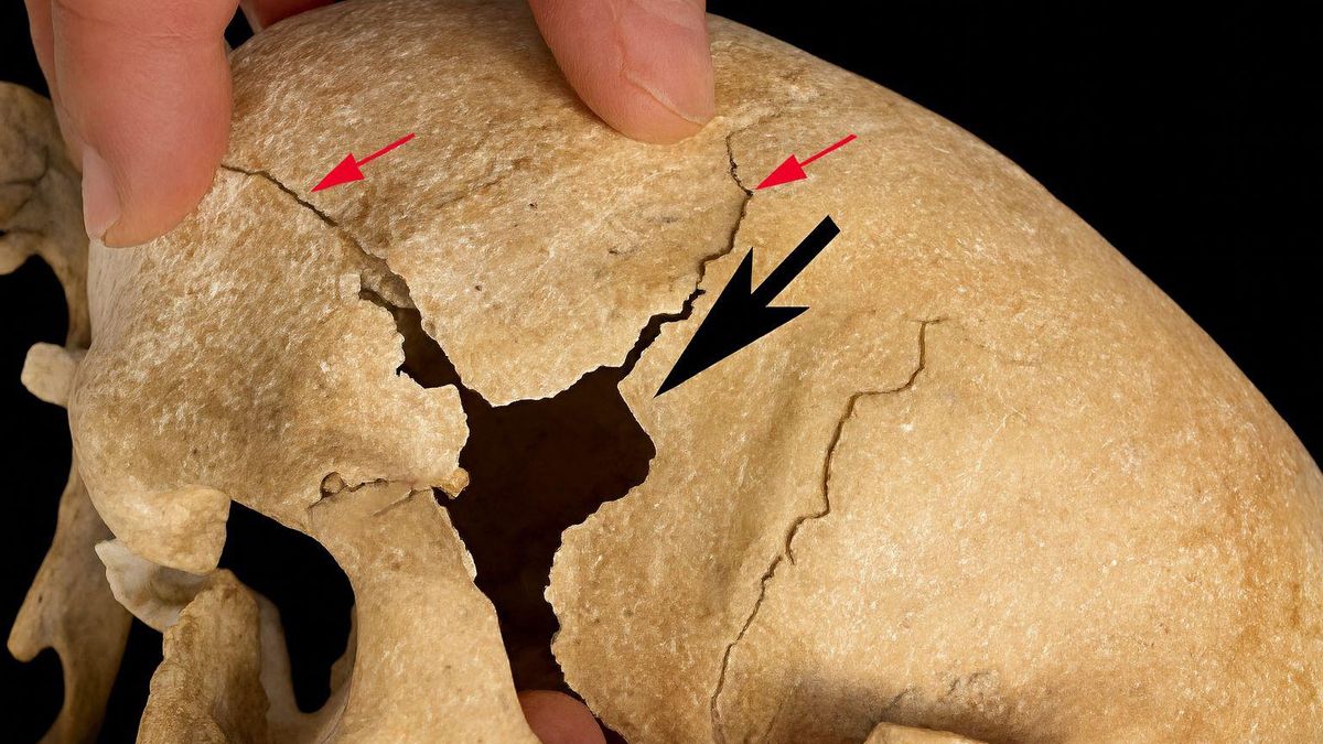 El hallazgo, sin precedentes en paleopatología, ofrece información directa sobre la adaptación humana y sobre el modo en que las órdenes militares combinaron devoción, cooperación y combate en la sociedad medieval