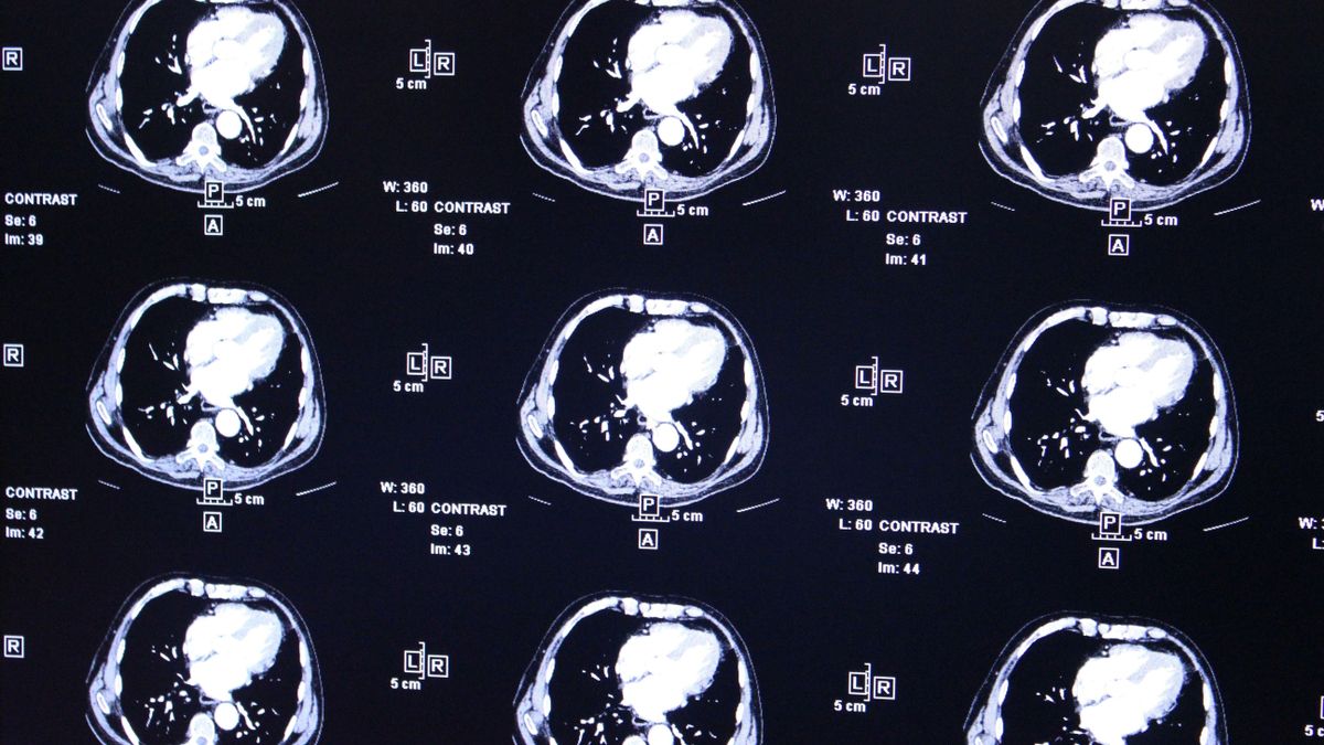 El centro de neurociencias HM CINAC lidera un estudio que muestra en primates la posibilidad de administrar terapia génica cerebral sin cirugía