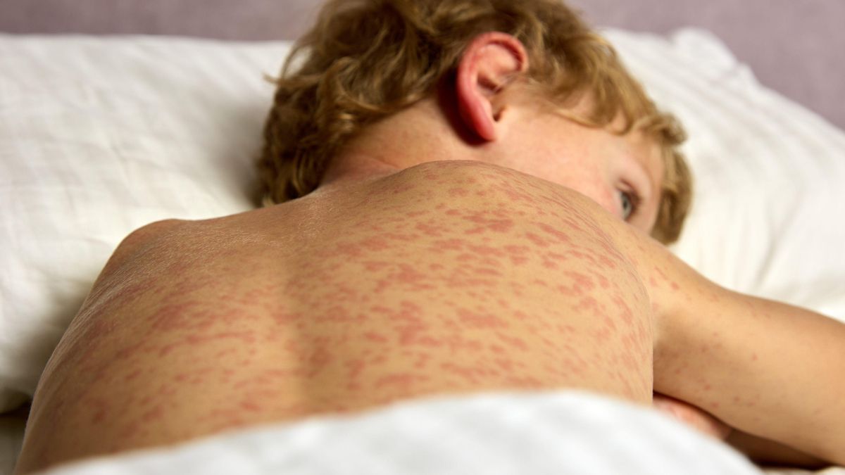 Se reactiva la transmisión endémica del sarampión en España debido a un alto porcentaje de contagiados no vacunados