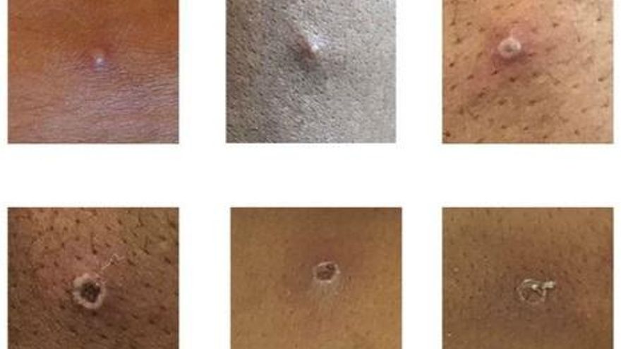 Una fiesta multitudinaria en Maspalomas, origen del segundo brote de la viruela del mono en España